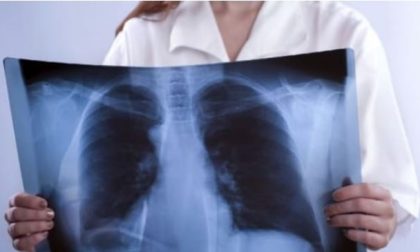 Tumore al polmone in primo piano: Lombardia ai vertici in Italia