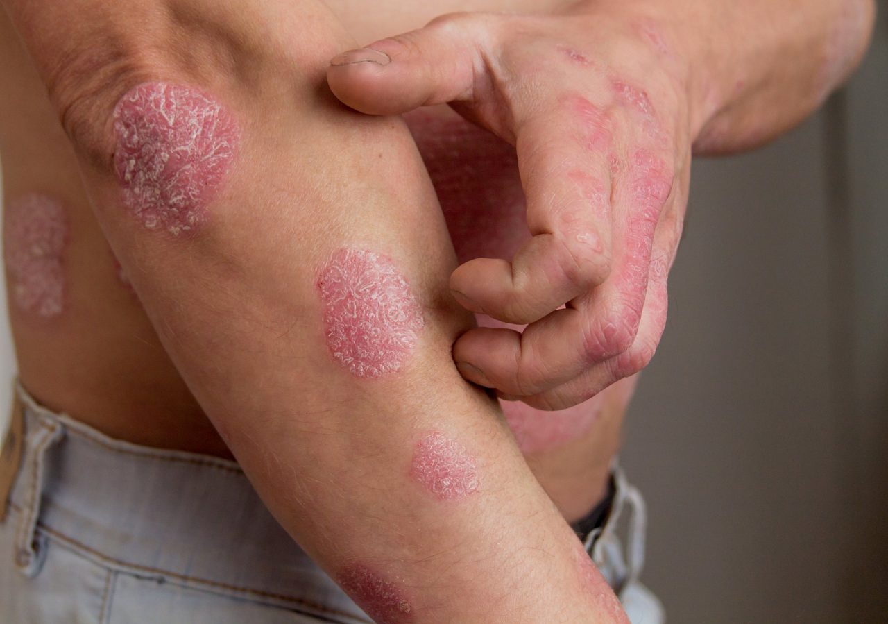 Che cosa è la psoriasi? Approccio alternativo alla malattia