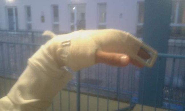 Prof perde staffe e rompe dito a studente disabile