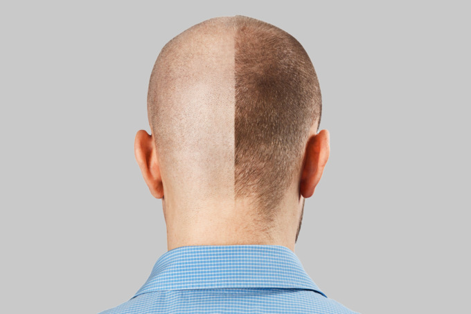 Nel trapianto dei capelli la risposta a tutti i problemi