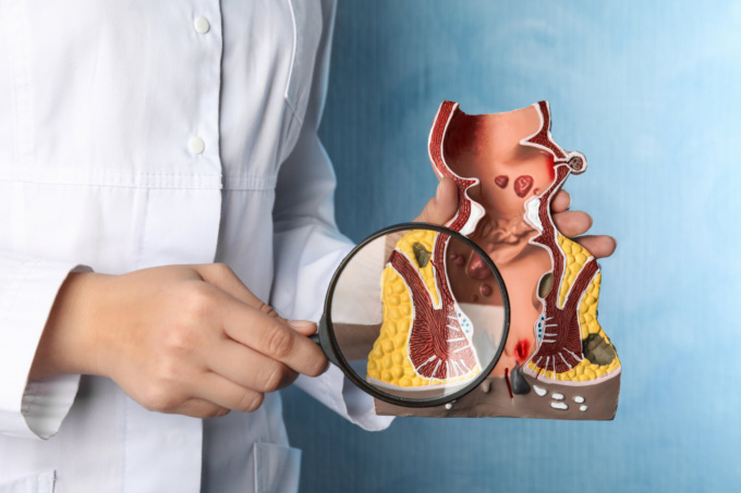 Emorroidi, sintomi e cura