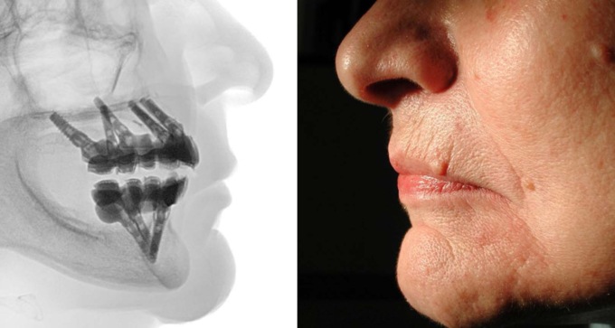 Implantologia dentale, ripristina i denti mancanti per un nuovo benessere