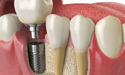 Riprendere a sorridere e masticare: cosa sapere sugli impianti dentali