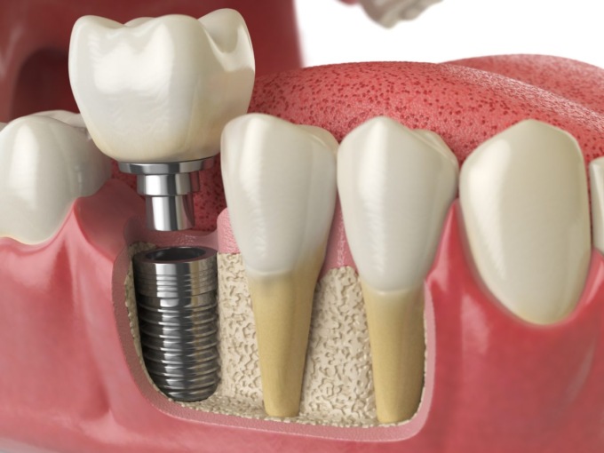 Riprendere a sorridere e masticare: cosa sapere sugli impianti dentali