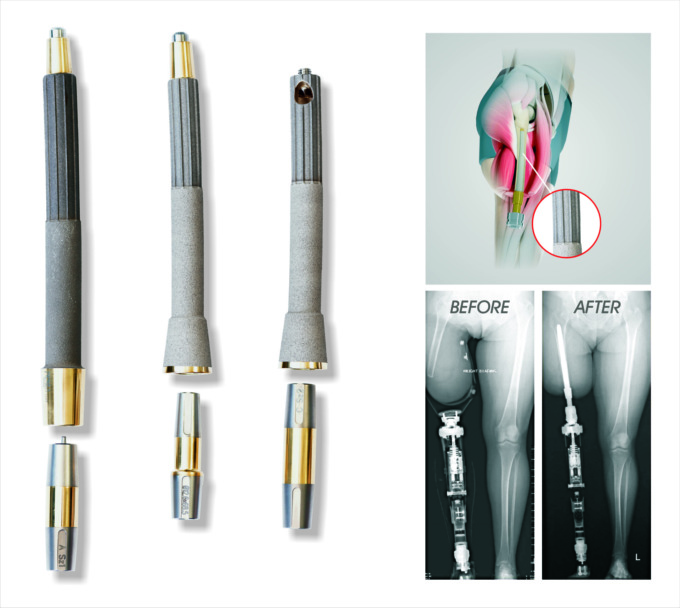 Osseointegration: partnership tra Permedica Orthopaedics di Merate e l’australiana Osseointegration