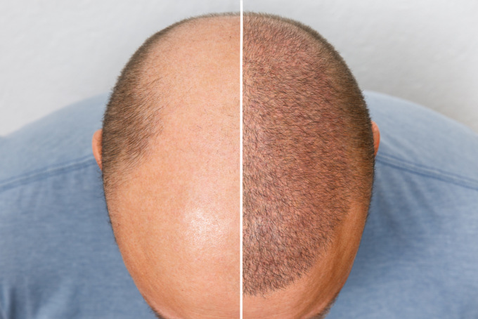 Perché sempre più italiani scelgono la Turchia per il trapianto di capelli