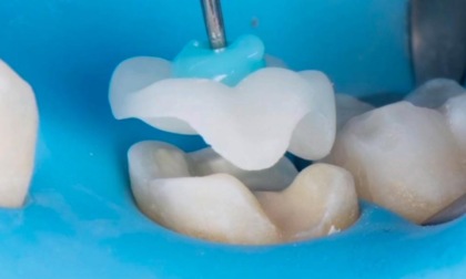 Il dentista spiega: l'odontoiatria conservativa
