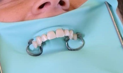 Il dentista spiega: cos’è la DIGA?