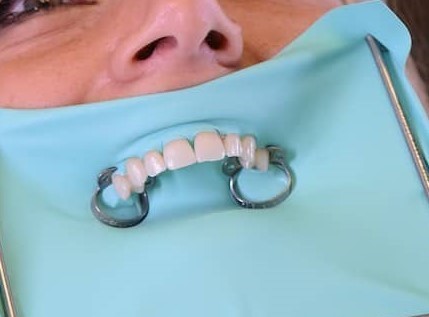 Il dentista spiega: cos’è la DIGA?