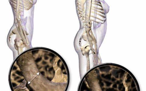 Osteoporosi e fragilità: un incontro a Lecco per sensibilizzare cittadini e operatori sanitari