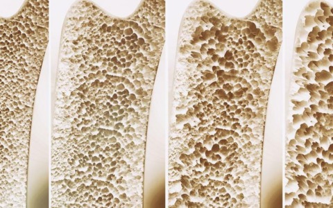 Osteoporosi: tema al certo dei Tè della Salute di SYNLAB