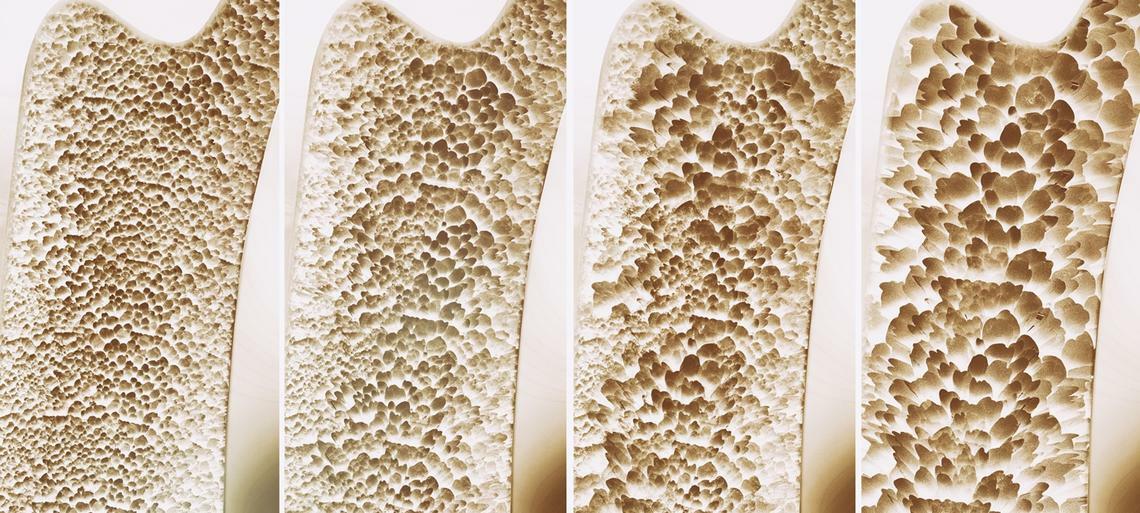 Osteoporosi: tema al certo dei Tè della Salute di SYNLAB